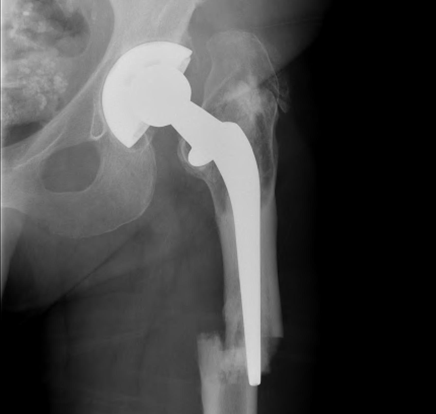 THR Periprosthetic Fracture Type B1